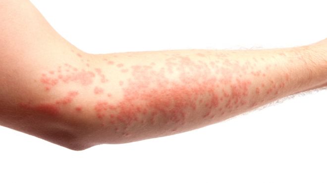 Soigner l’eczéma par l'hypnothérapie