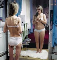 L’hypnothérapie, une solution naturelle contre l’anorexie